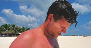 treat sunburn